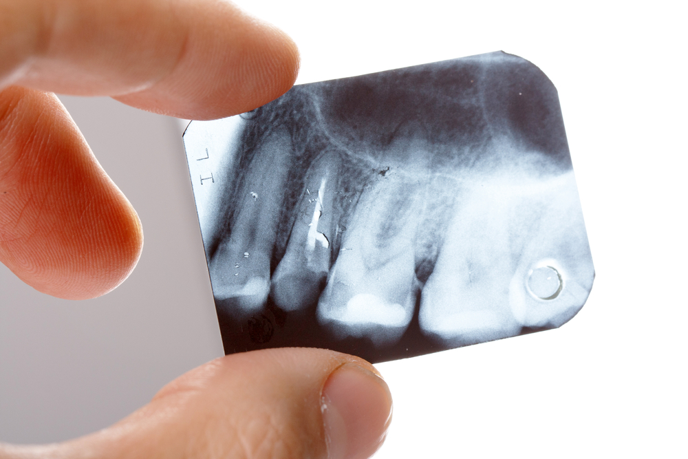 Why it costs you MORE for not taking dental X-ray