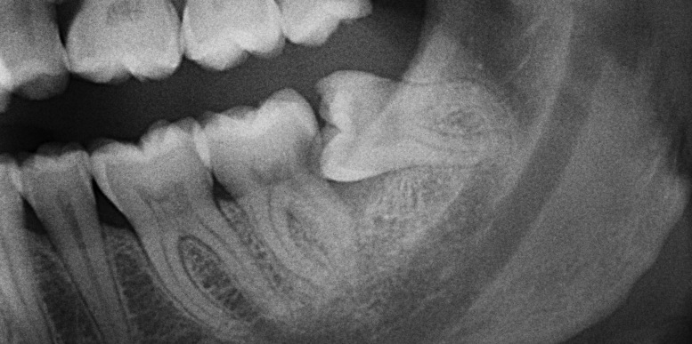 wisdom tooth