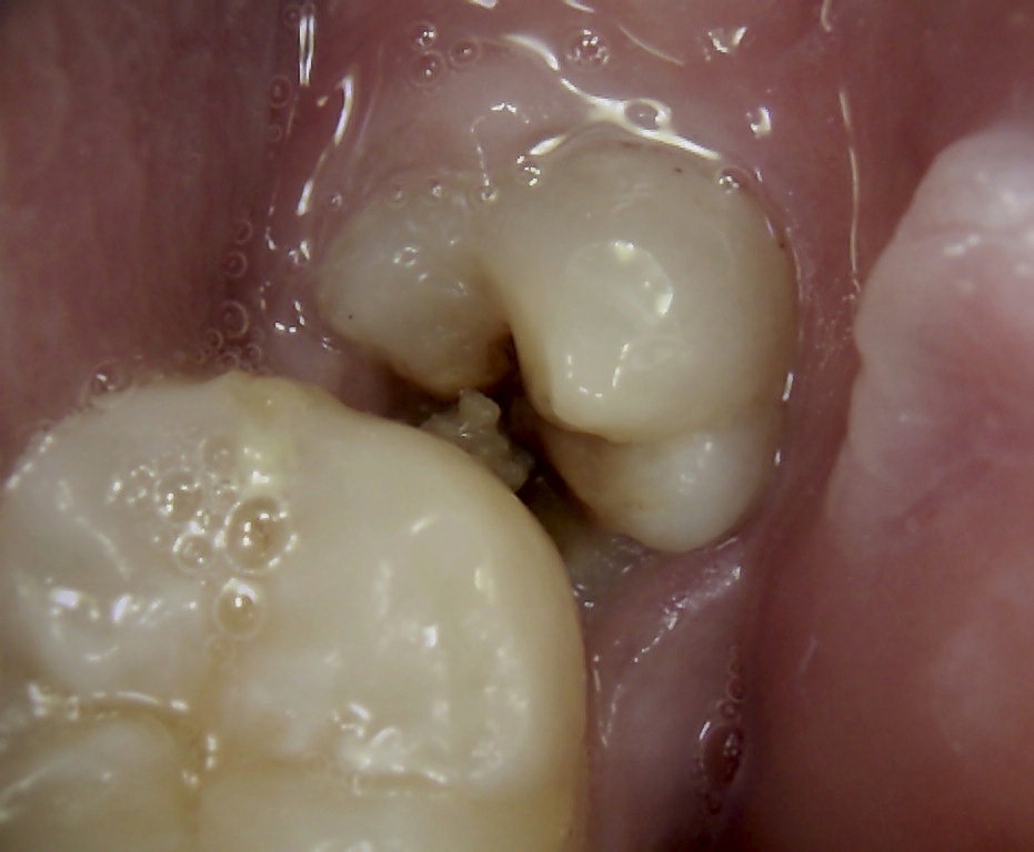 wisdom teeth holes infection