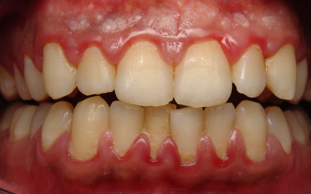 Gum diseases… what is it?