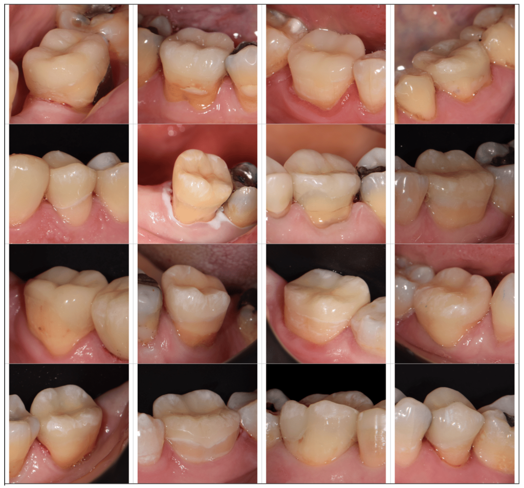 How To Replace Tooth Cap