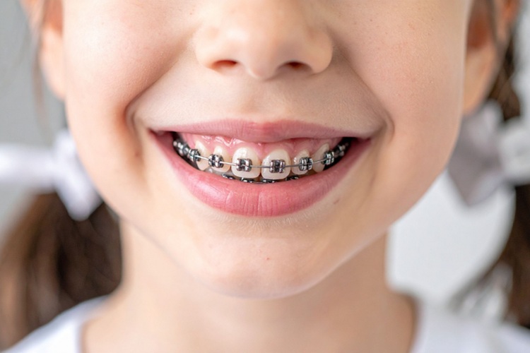 smiling kids orthodontic patient at supa dental in melton