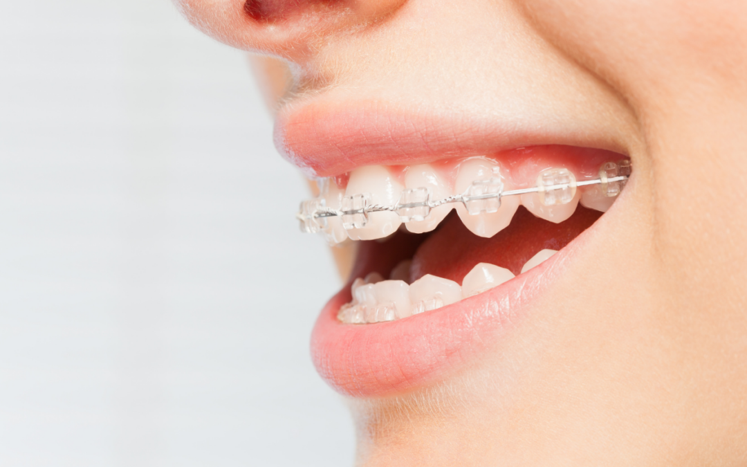 How Long Do Braces Take? (And What Can Make Treatment Longer?)